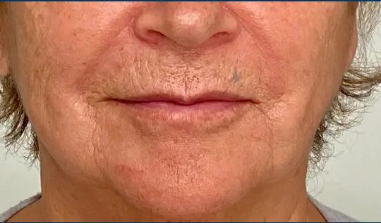 Cambios en los labios con el tiempo